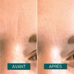 Patchs Anti-rides Pour Le Front Down The Frown - Apricot -AEGIS PHARMA 506