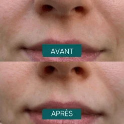 Patchs Anti-rides Pour La Bouche Keep Smiling - Apricot -AEGIS PHARMA 507