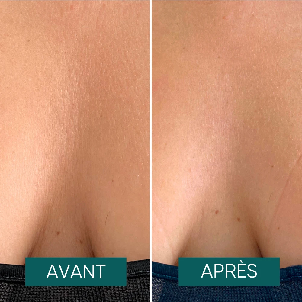 Patch Pour Décolleté Réutilisable à L'aloe Vera One Calm Away- Apricot 3 Patch Pour Décolleté Réutilisable à L'aloe Vera One Calm Away- Apricot – Image 3