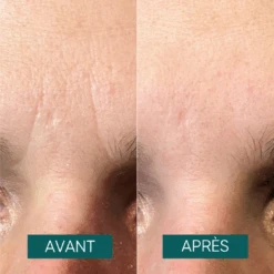 Patchs Pour Le Front à La Niacinamide It's A Skin-vestment - Apricot 6 Patchs Pour Le Front à La Niacinamide It's A Skin-vestment - Apricot -AEGIS PHARMA 603