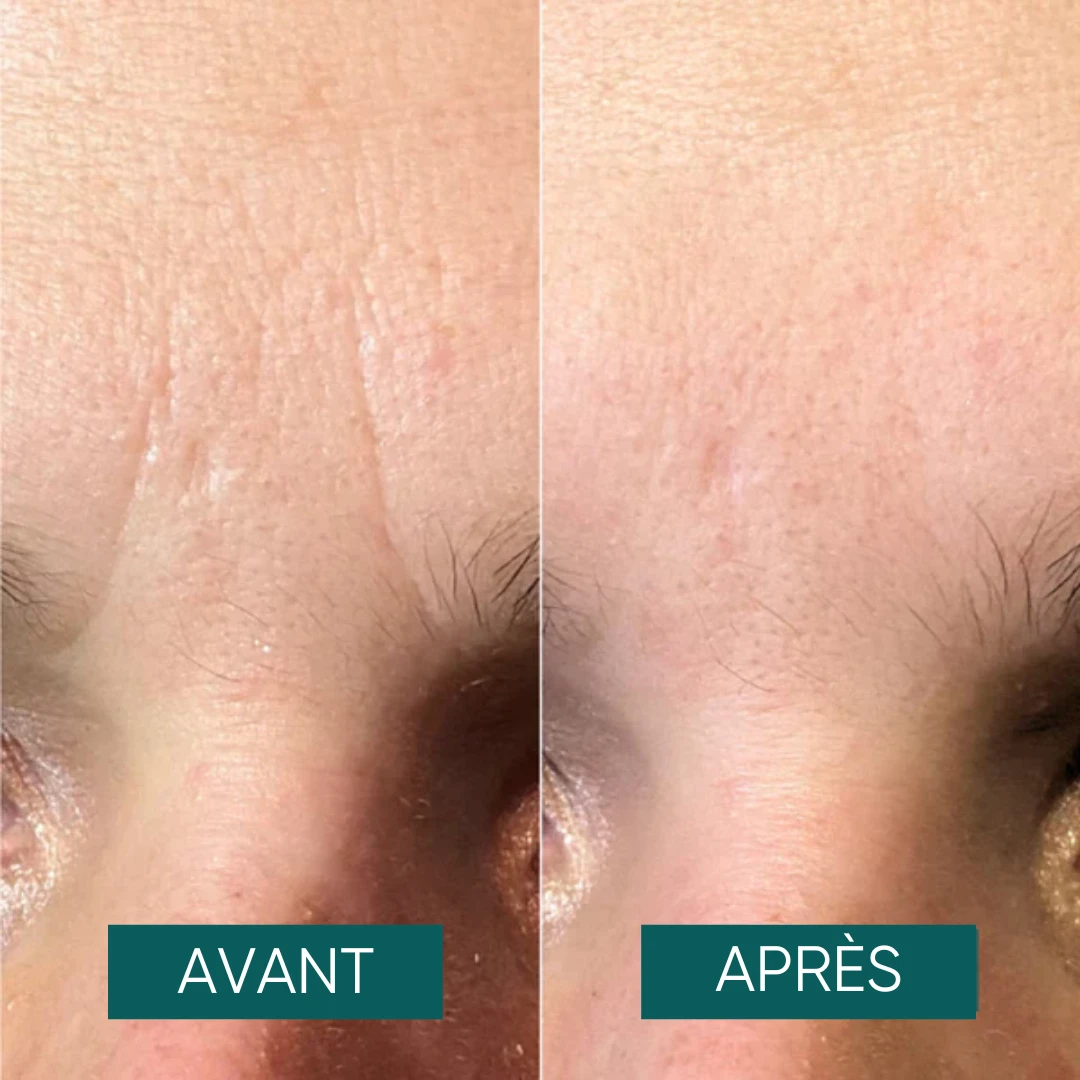 Patchs Pour Le Front à La Niacinamide It's A Skin-vestment - Apricot 3 Patchs Pour Le Front à La Niacinamide It's A Skin-vestment - Apricot – Image 3